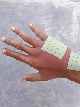 Swollen back of the palm due to dislocated of the bones 스톡 사진