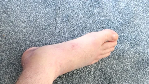 A Swollen Damaged Ankle With Ligament Damage 스톡 동영상 136903536