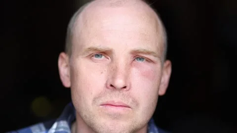 Swollen face after a bee sting Stock Footage 190038034