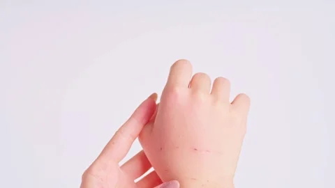 Swollen female hand with cat bite marks and scratches Vidéo 347121770