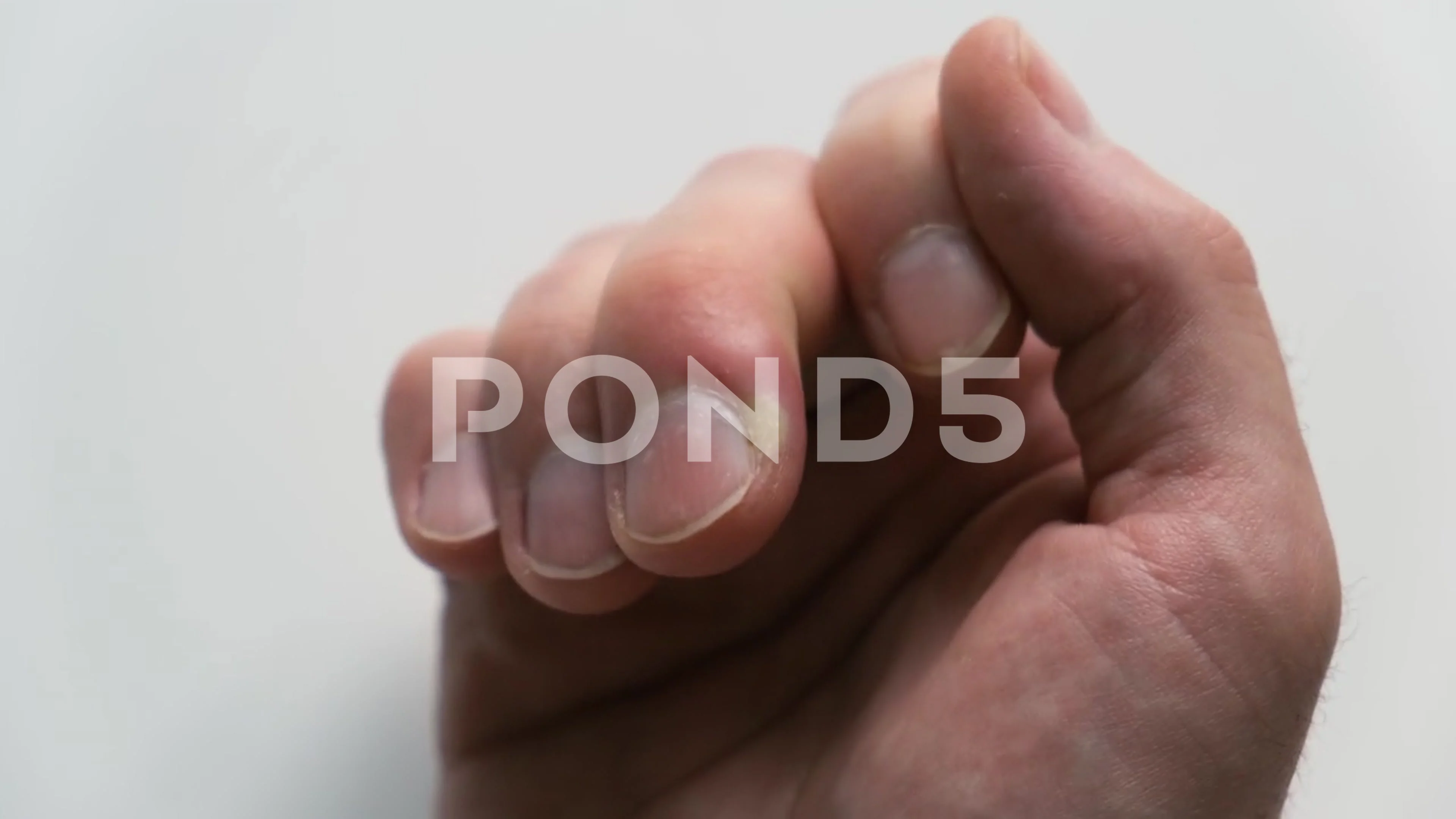 Paronychia, Swollen Finger Inflammation Due To Bacterial Infection on a Man  Hand. Wound Infection on the Skin Stock Image - Image of diabetes, disease:  228215819