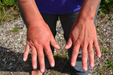 Swollen hand Stock Photos
