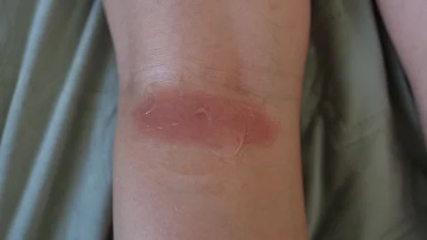 Swollen insect bite on the leg causes redness and inflamed skin with clear irrit Stock Footage 312325202
