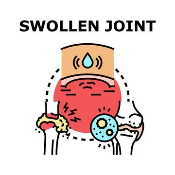 Swollen joint condition causing pain and inflammation Illustrazione stock