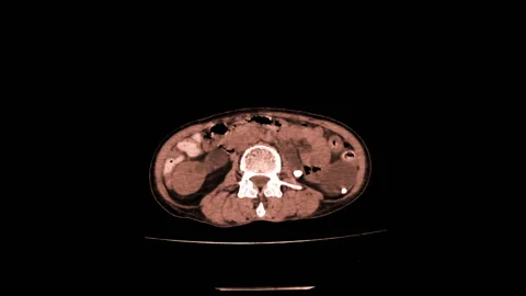 Swollen kidneys, CT scan Stock Footage 178669562