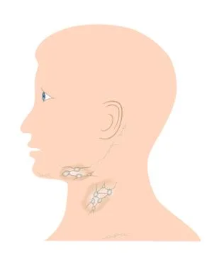 Swollen lymph nodes Stock Illustration