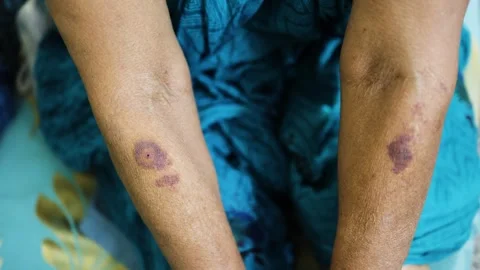 Swollen mosquito bite mark causing a red wheal Stock Footage 319670032