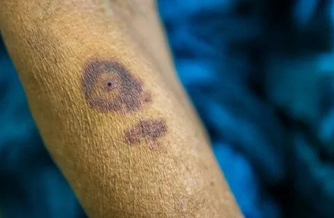 Swollen mosquito bite mark causing a red wheal 写真素材