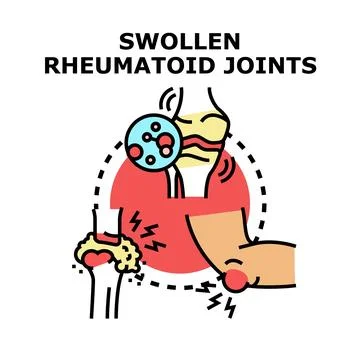 Swollen rheumatoid joints causing pain and inflammation Illustrazione stock