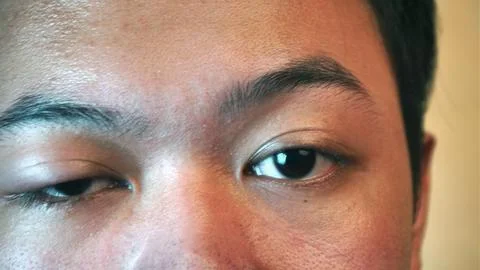 Swollen right eye Stock Photos