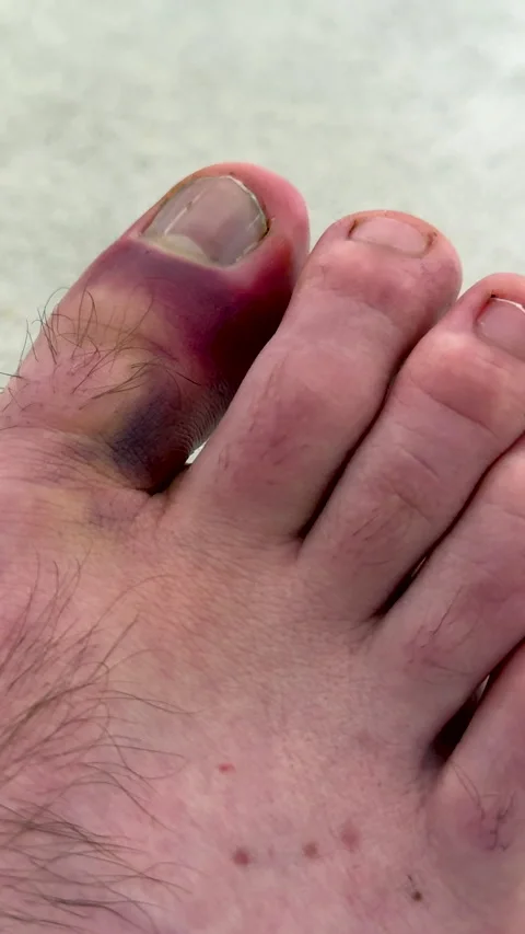 Swollen toe with visible hematoma shown in three sequential frames, highlighting 스톡 동영상 336546189