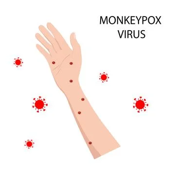 Symptom of monkeypox on the human body. Monkey pox. Vector illustration Stock Illustration
