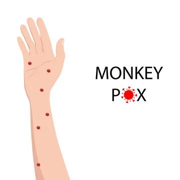 Symptom of monkeypox on the human hand. Monkey pox Stock Illustration
