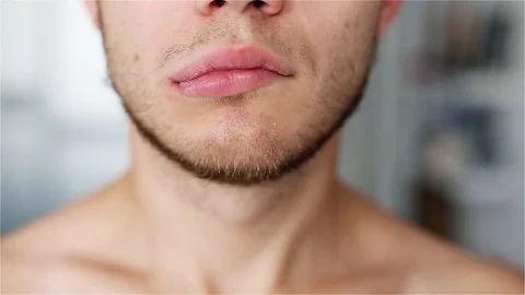 Symptoms and effects of a brain stroke. asymmetry of the face lips man. Stock Footage 96218650