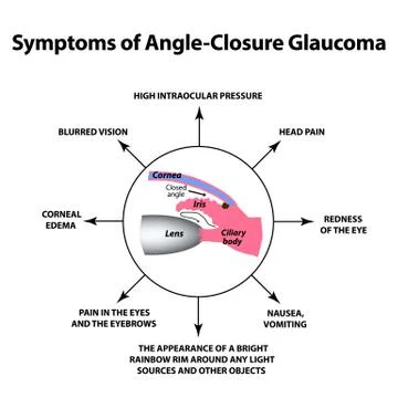 The symptoms of closed angle glaucoma. World glaucoma day. The anatomical Stock Illustration