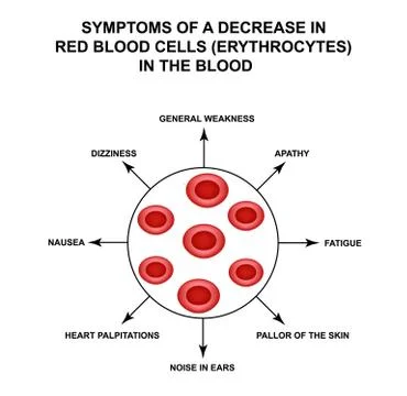 Symptoms of a decrease in red blood cells in the blood. Cells erythrocytes 库存插图