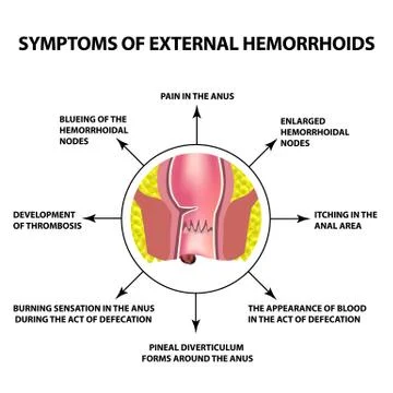 Symptoms of external hemorrhoids. The hemorrhoidal node in the rectum, anus Stock Illustration