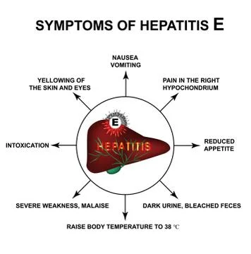 Symptoms of Hepatitis E. World Hepatitis Day. Infographics. Vector illustration Illustrazione stock