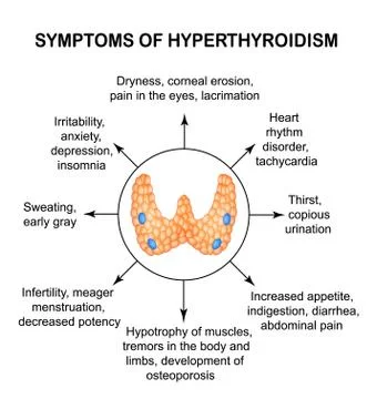 Symptoms of hyperthyroidism. Thyroid. Infographics. Vector illustration on Stock Illustration