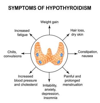 Symptoms of hypothyroidism. Thyroid. Infographics. Vector illustration on Stock Illustration