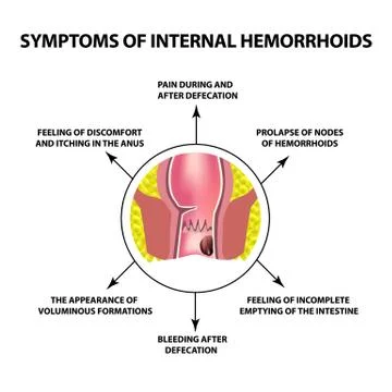 Symptoms of internal hemorrhoids. The hemorrhoidal node in the rectum, anus Stock Illustration