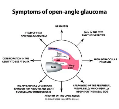 Symptoms of open-angle glaucoma. World glaucoma day. The anatomical structure of Stock Illustration