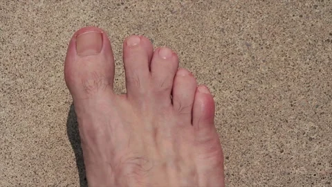 Syndactyly between long second toe and middle third toe on adult male foot Stock Footage 247143746