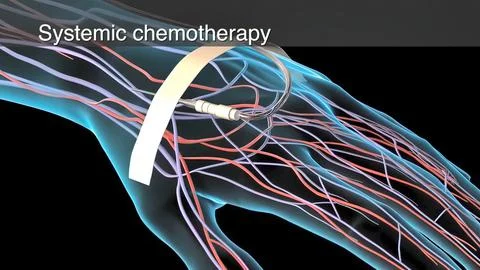 Systemic chemotherapy Stock Illustration
