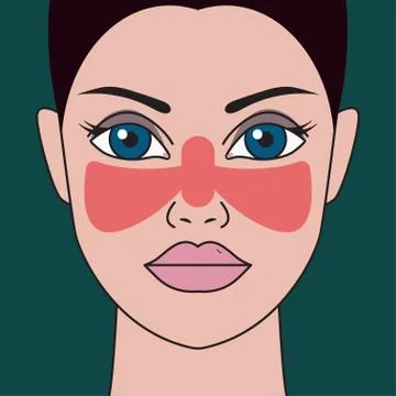 Systemic lupus erythematosus Stock Illustration
