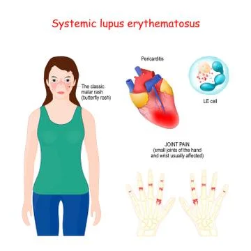 Systemic lupus erythematosus Stock Illustration