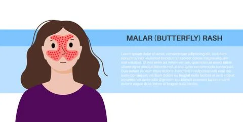 Systemic lupus erythematosus Stock Illustration