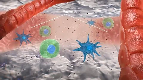 T cell macrophage interactions and granuloma formation in vasculitis Stock Illustration