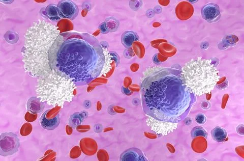 T-cells attack acute myeloid leukemia (AML) cells in blood flow Illustrazione stock