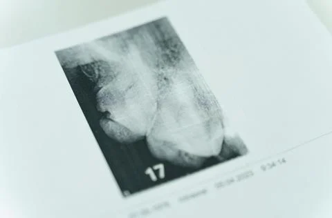On the table is a close-up printout of two teeth Stock Photos
