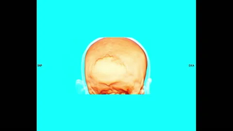 TAC 3D Volume - Skull bone + skin - Full HD - ProRes Stock Footage 166204822