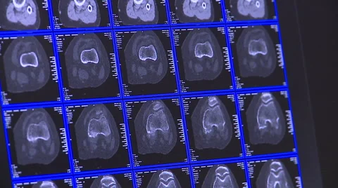 TAC Brain scan Stock Footage 62618477