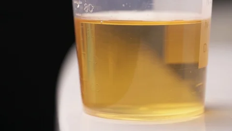 Taking of a sample of urine with a pipette. A close-up demonstration video. Stock Footage 105069605