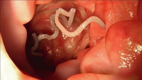Tapeworm in human intestine Stock Footage 75604092
