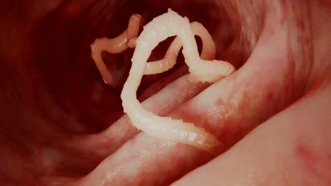 Tapeworm in human intestine. 스톡 동영상 242994701