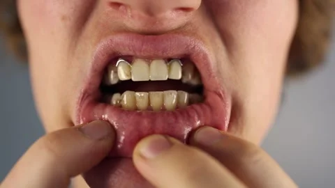 Tartar buildup clearly visible on lower teeth as lips are pulled down revealing  Stock Footage 312201689