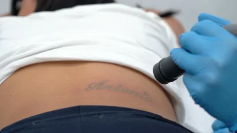 PicoWay Tattoo Removal Treatment - Kitagawa Dermatology