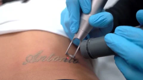 Tatoo eraser machine session deleting or removing Tato professionaly 库存影片 231995759