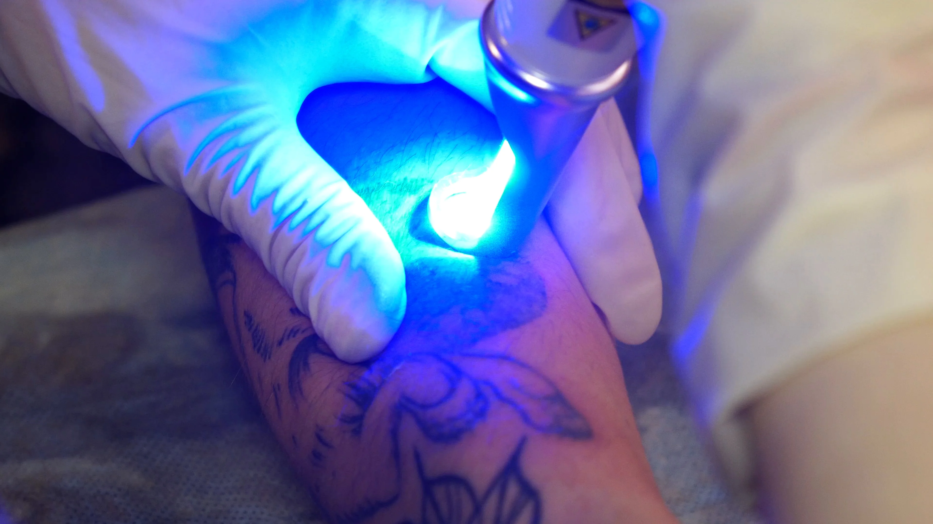Laser Tattoo Removal - Bodyology