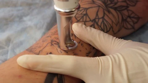 Tattoo removal laser. A young girl removes the tattoo with a laser. Stock Footage