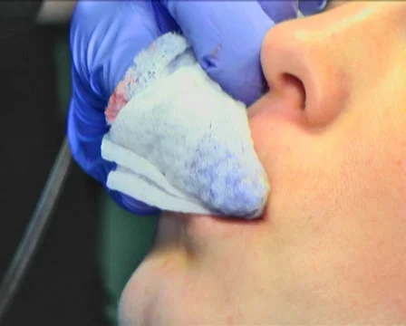 Tattooing of Lips 19 Stock Footage 35016629