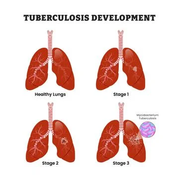 TB Tuberculosis Development Stages Diagram Process, educational medical pos.. Stock Illustration