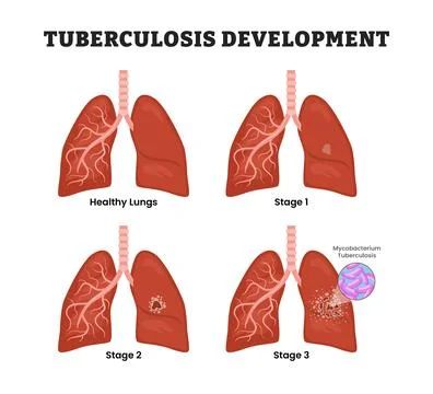 TB Tuberculosis Development Stages Diagram Process, educational medical pos.. Stock Illustration