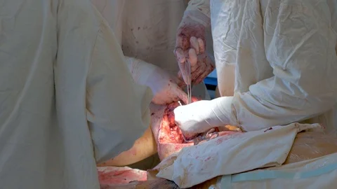 A team of doctors makes a very complicated operation on the foot of the patient Stock Footage 95442328