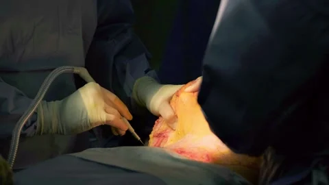 A team of doctors - surgeons performing a surgical operation Stock Footage 270469238