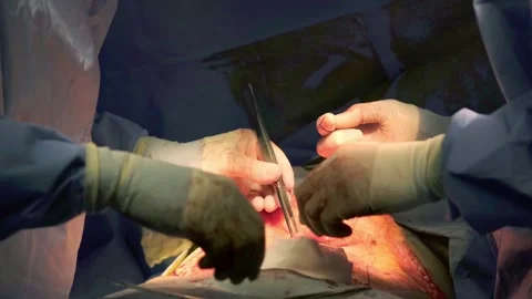 A team of doctors - surgeons performing a surgical operation Stock Footage 270469988